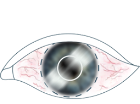 An illustration of an eye with blurred vision