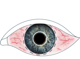 An illustration of a dry eye