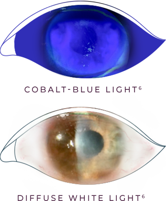 Fluorescein staining of an eye with stage 1 (mild) neurotrophic keratitis (NK) as seen under cobalt blue light and An eye with stage 1 (mild) neurotrophic keratitis (NK) as seen under diffuse white light