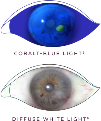 Fluorescein staining of an eye with stage 2 (moderate) neurotrophic keratitis (NK) as seen under cobalt blue light and An eye with stage 2 (moderate) neurotrophic keratitis (NK) as seen under diffuse white light