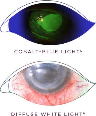 Fluorescein staining of an eye with stage 3 (severe) neurotrophic keratitis (NK) as seen under cobalt blue light and An eye with stage 3 (severe) neurotrophic keratitis (NK) as seen under diffuse white light