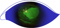 Fluorescein staining of an eye with stage 3 (severe) neurotrophic keratitis (NK) as seen under cobalt blue light