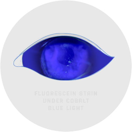 Fluorescein staining of an eye with stage 1 (mild) neurotrophic keratitis (NK) as seen under cobalt blue light