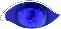 Fluorescein staining of an eye with stage 1 neurotrophic keratitis (NK) as seen under cobalt blue light